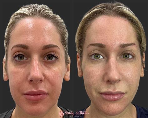 Before and After Results Gallery .